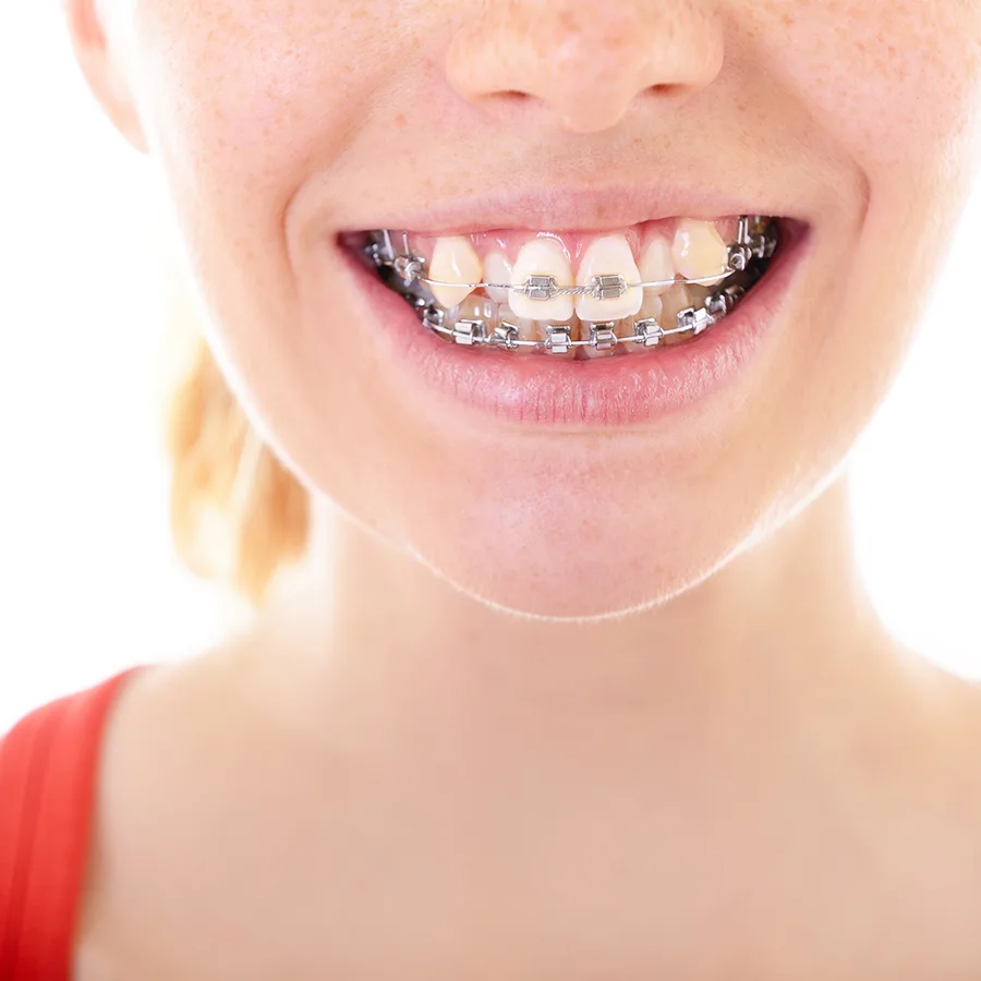 Crooked Teeth Treatment